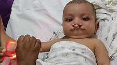 Cleft baby injections before surgery