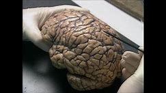 The Human Brain Anatomy