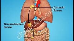 Carcinoid tumörer: Orsaker, symtom, diagnos och behandling - Cancer 2024