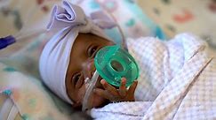 World's smallest baby leaves hospital