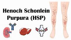 Henoch Schonlein Purpura (HSP) - Causes, Signs & Symptoms, Complications, Diagnosis & Treatment