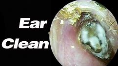 Ear Picking Earwax Affects Hearing In Ears That Haven't Been Cleaned In 30 Years