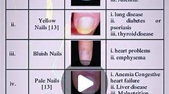 Nb on Instagram: "Important disease #nail #disease #name in English #and #effective nails"