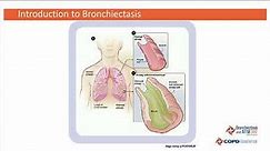 Introduction to Bronchiectasis with Tim Aksamit, MD