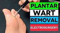 FAST Plantar Wart Removal By Electrosurgery