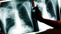 La FDA aprueba nuevo tratamiento para la tuberculosis altamente resistente a los medicamentos