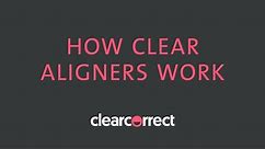 How clear aligners work