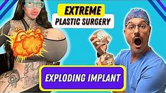 Huge Breast Implants - Extreme surgery