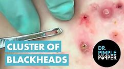 50 Minutes of Blackheads! Clusters of Blackheads with Dr. Pimple Popper