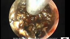 Earwax Removal Extraction,The first case of giant external auditory meatus cholesteatoma in 2018