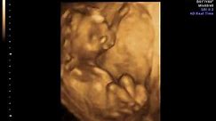 4D ultrazvučni snimak bebe u 16 nedelji trudnoće - Ginekološka ordinacija Anđelić.