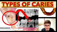 CARIES for Beginners! | Clinical Vs Bitewings (ICDAS classification, IOS caries detector, Trios 5)