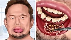 ASMR Remove maggots from Elon Musk's lower lip | WOW Brain Treatment Animation