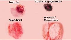 Basal Cell Carcinoma (epithelioma) animation