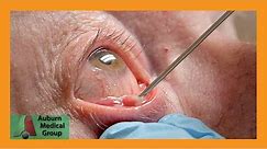 STYE Gets Punctured for Pus Drainage | Auburn Medical Group