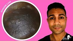 1,446 - Stubborn Grade III Keratosis Obturans Removal using Ear Pick & Forceps & Microsuction