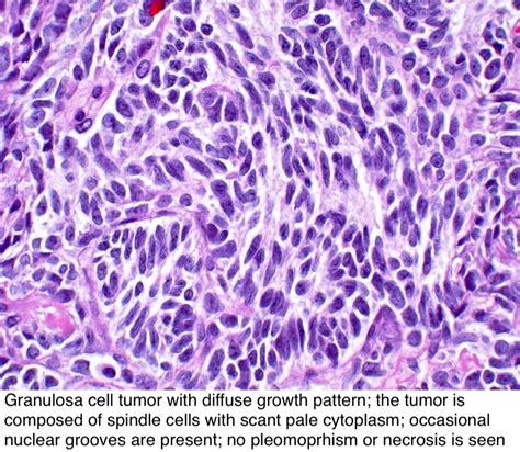 pathology outlines sex cord stromal tumors general