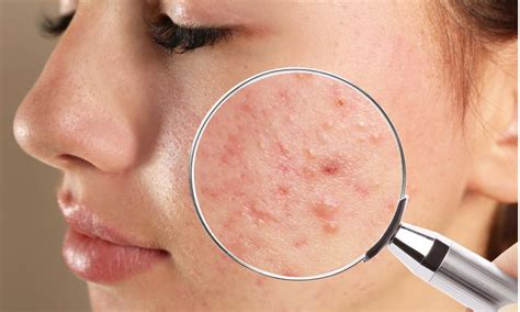 bacterial  fungal acne dermatologists located  manhattan