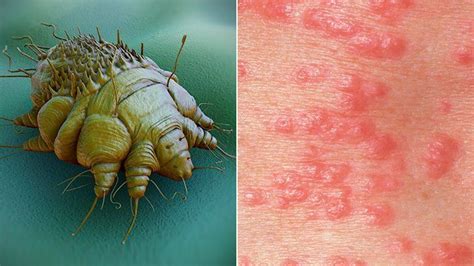what is scabies symptoms causes diagnosis treatment and prevention