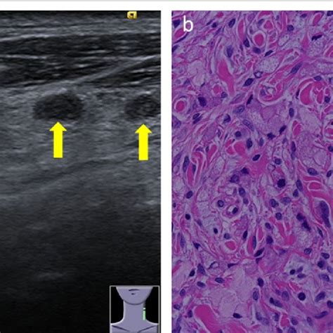 Ultrasonography And Pathological Findings In Cervical Lymph Nodes A
