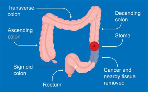 Understanding Colon Cancer Screening Gastrointestinal Diseases Inc