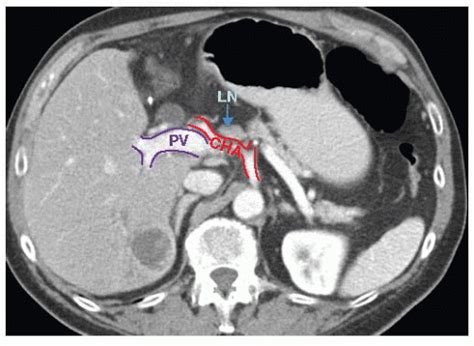 Surgical Anatomy Of The Liver Basicmedical Key