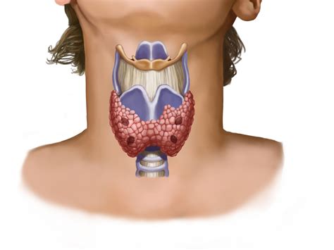 overdiagnosis    jump  thyroid cancer cases ncpr news
