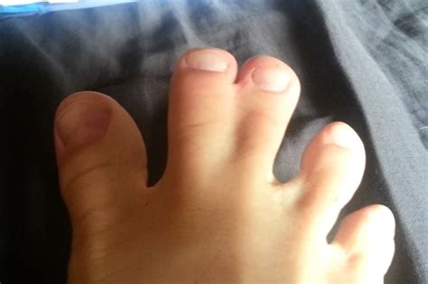 Webbed Toes Causes Diagnosis Surgery And Pictures