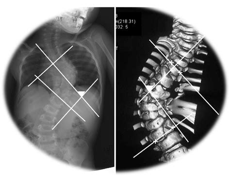 Story On Scoliosis Backpro Integrated Health Clinic En
