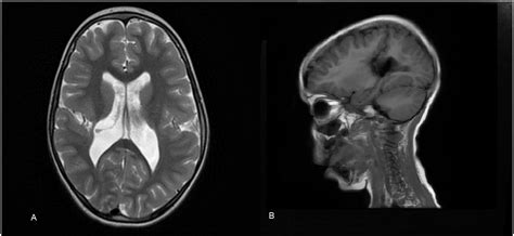 unilateral closed lip schizencephaly international journal