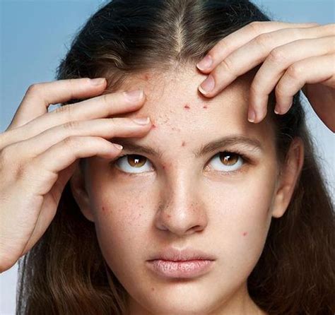 home remedies  pimples