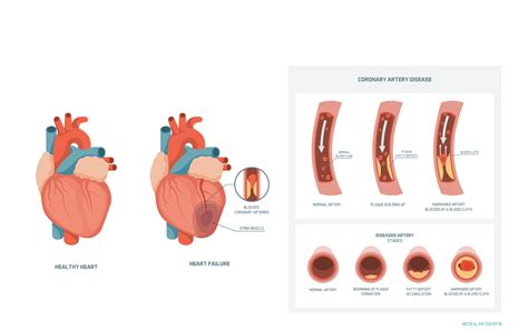 risk factors      coronary artery disease cad