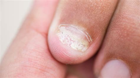 zastrzal palca  paznokcia poznaj przyczyny  objawy jak leczyc