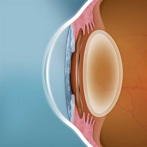 implantable contact collamer lens dr lynn yeo experienced eye surgeon singapore