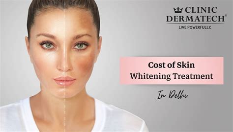 cost  skin whitening treatment  delhi clinic dermatech