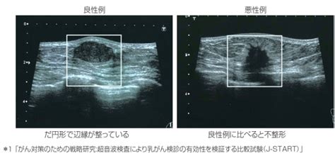 乳がんは日本人女性が最もかかるがんです ～30代から増え始める乳がん～｜地方独立行政法人 筑後市立病院