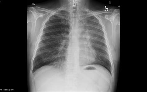 Luftsichel Sign Left Upper Lobe Collapse Frontal Chest X Ray