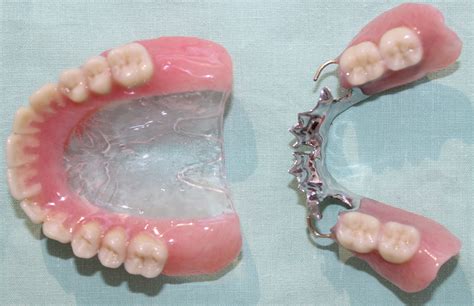 metal partial denture   complete upper denture