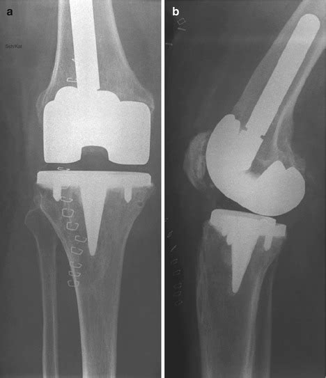 discussion  chap  persistent anterior knee pain  total knee