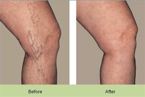Face And Leg Veins Uk Cosmetic Clinic