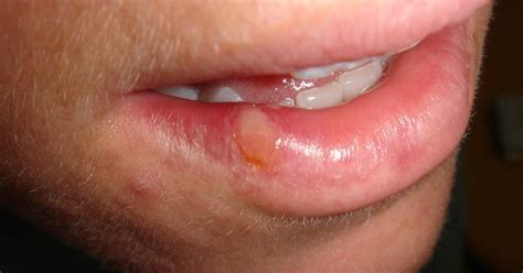 Herpes Labialis Topical Treatments And Herbal Remedies Herpes