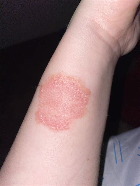 ringworm        weeks   doesnt itch  bother
