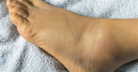 Swollen Feet 15 Causes Treatments And Home Remedies