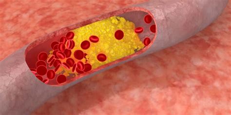 cholesterin senken zielwerte ernaehrung lebensstil und medikamente