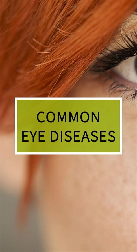 Common Eye Diseases Diy Herbal Remedies Common Eye Diseases Herbal Cure