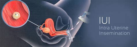 iui intrauterine insemination facts