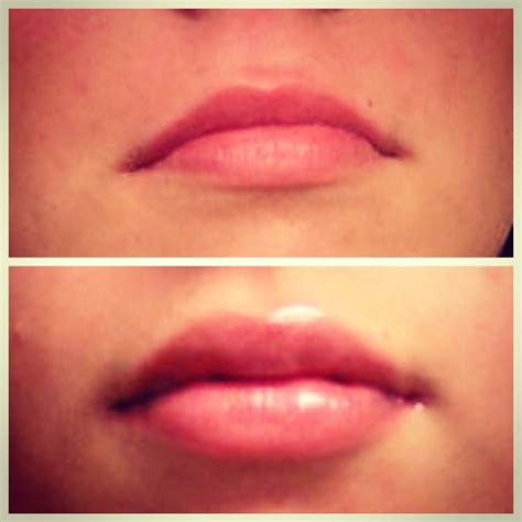 Before And After Photos Juvederm Filled Lips