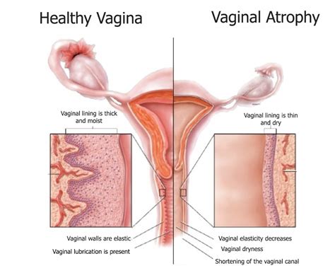 vaginal dryness during intercourse mature milf