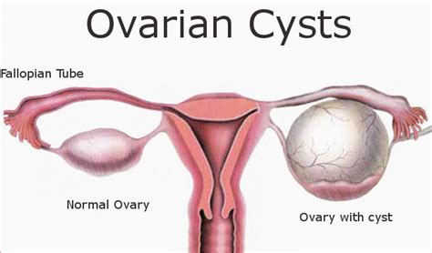 types of cysts in women