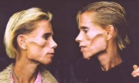 Famous Anorexic Identical Twins Die In House Fire